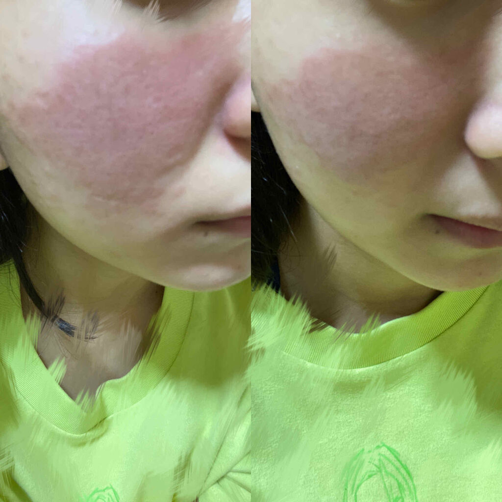 エピデュオゲル/マルホ株式会社/その他を使ったクチコミ（3枚目）