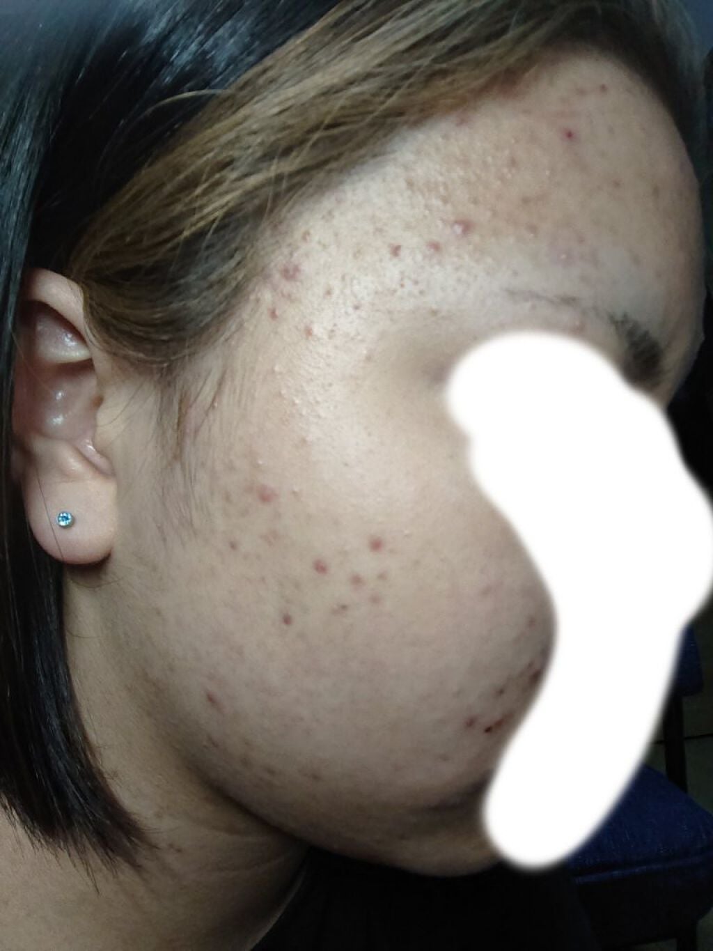 ゆう on LIPS 「小学校の時からニキビに悩んでいます。色々試しましたがあまり効果..」(1枚目)