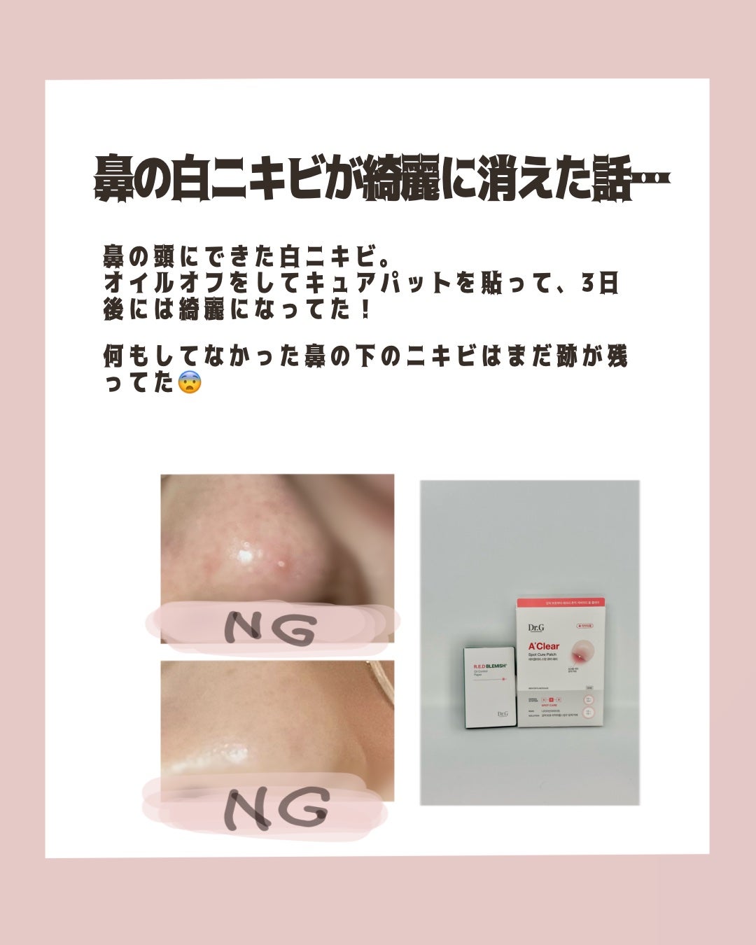 エイクリアスポットキュアパッチ/Dr.G/その他スキンケアを使ったクチコミ(3枚目)