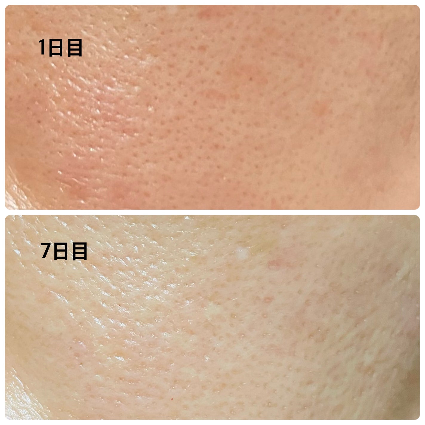 シカレチA エッセンス0.7/VT/美容液を使ったクチコミ(5枚目)