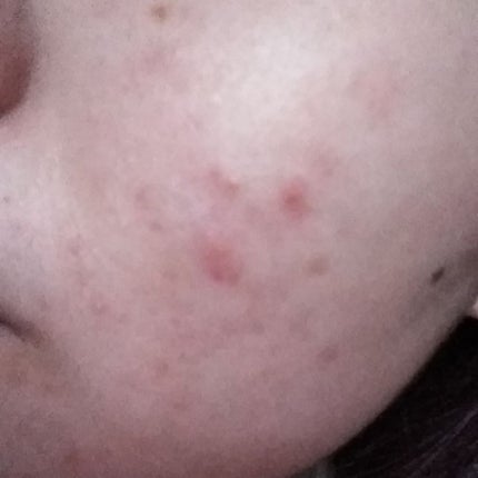 ロゼット洗顔パスタ アクネクリア/ロゼット/洗顔フォームを使ったクチコミ(2枚目)