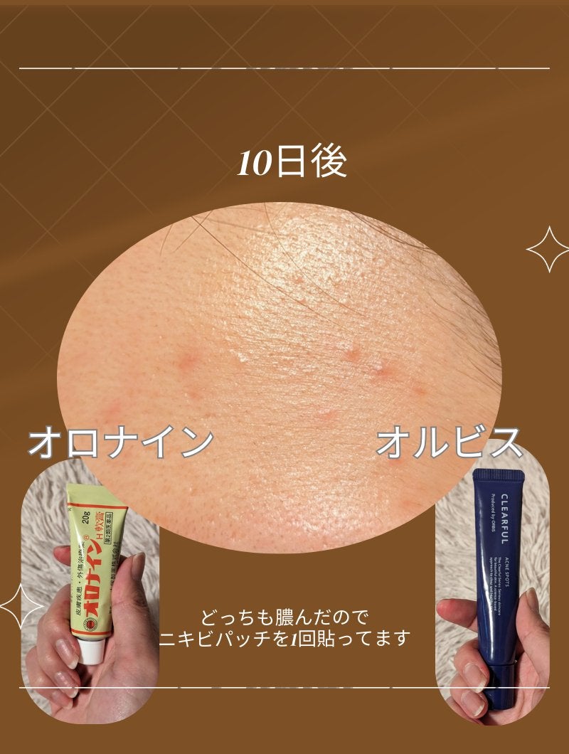 オロナインH軟膏 (医薬品)/オロナイン/その他を使ったクチコミ(5枚目)