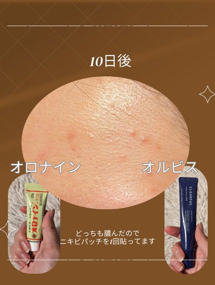 オロナインH軟膏 (医薬品)/オロナイン/その他を使ったクチコミ(5枚目)