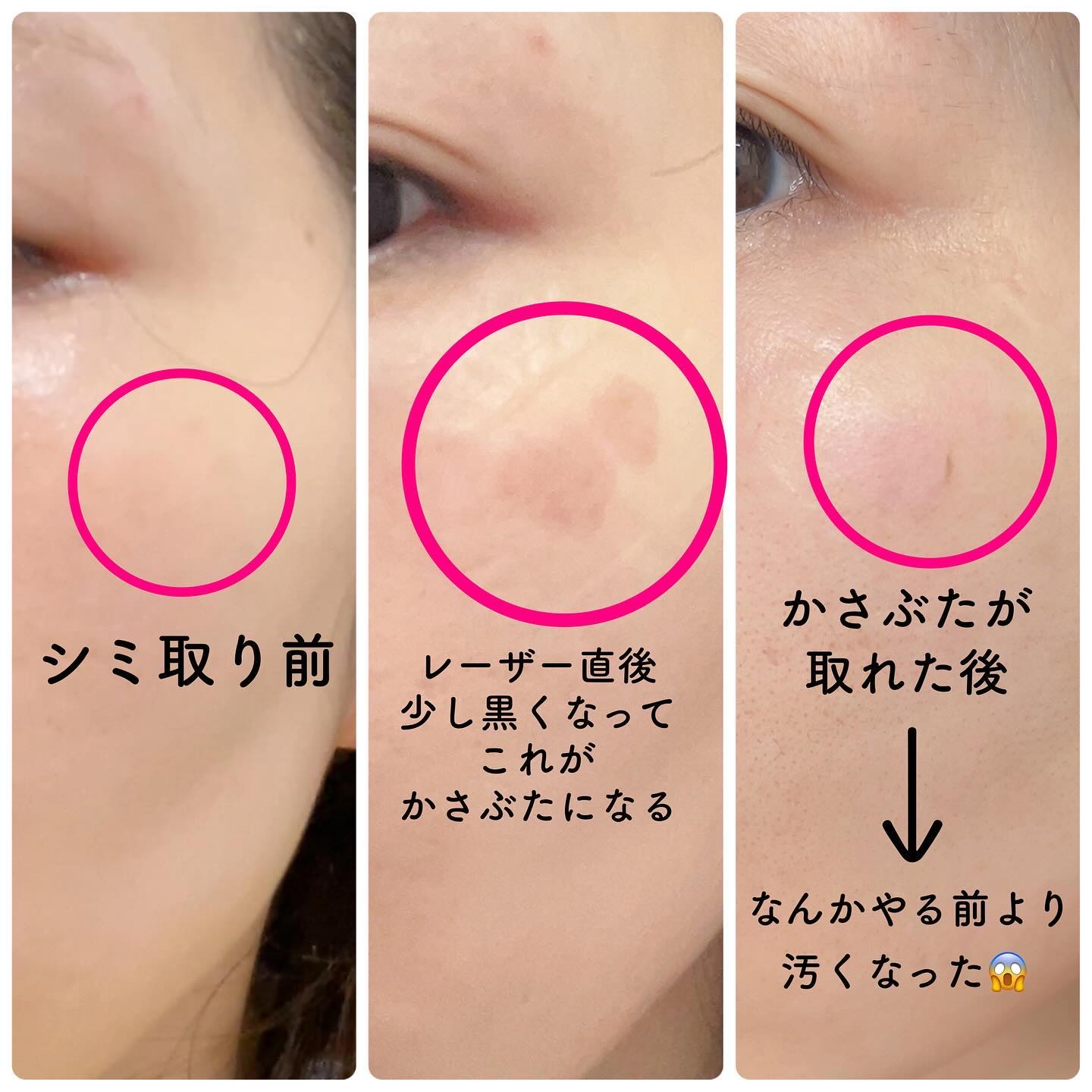 3月限定価格‼️ SBC  湘南美容外科　ナノメゾットHQ   新品未使用 SBCナノメソッドHQ・VAでシミ・色素沈着・くすみ・シワ・毛穴改善