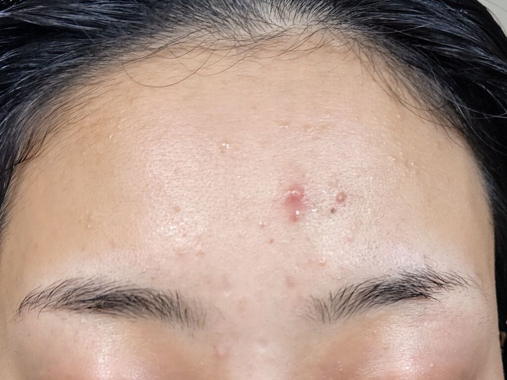 オードムーゲ 薬用ローション（ふきとり化粧水）/オードムーゲ/拭き取り化粧水を使ったクチコミ（2枚目）