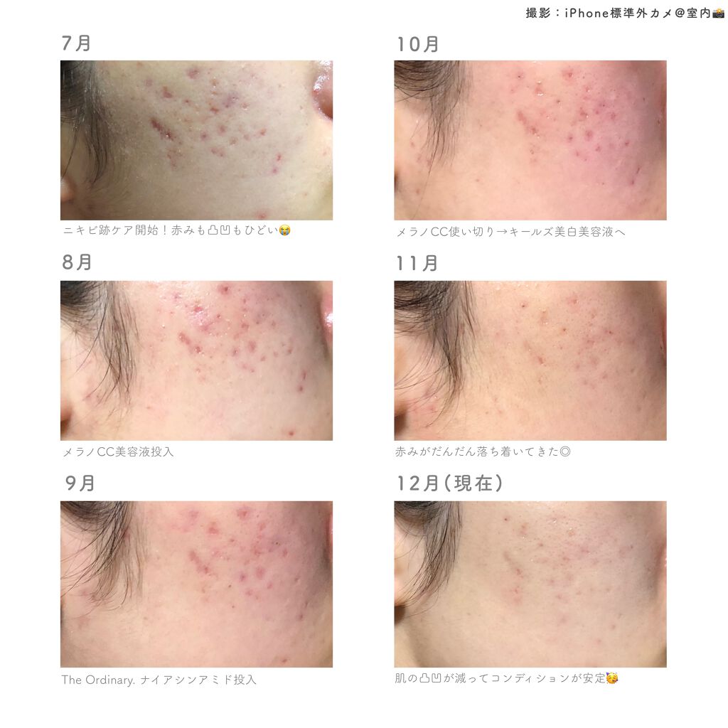 スキンケア方法 キールズ Ds クリアリーホワイト ブライトニング エッセンス Kiehl Sの使い方 効果 自己流ニキビ跡ケア記録 By ミ ナ ミ 混合肌 代前半 Lips スキンケア方法 キールズ Ds クリアリーホワイト ブライトニング エッセンス Kiehl Sの使い方 効果 自己流ニキビ跡ケア記録 By ミ ナ ミ 混合肌 代前半 Lips