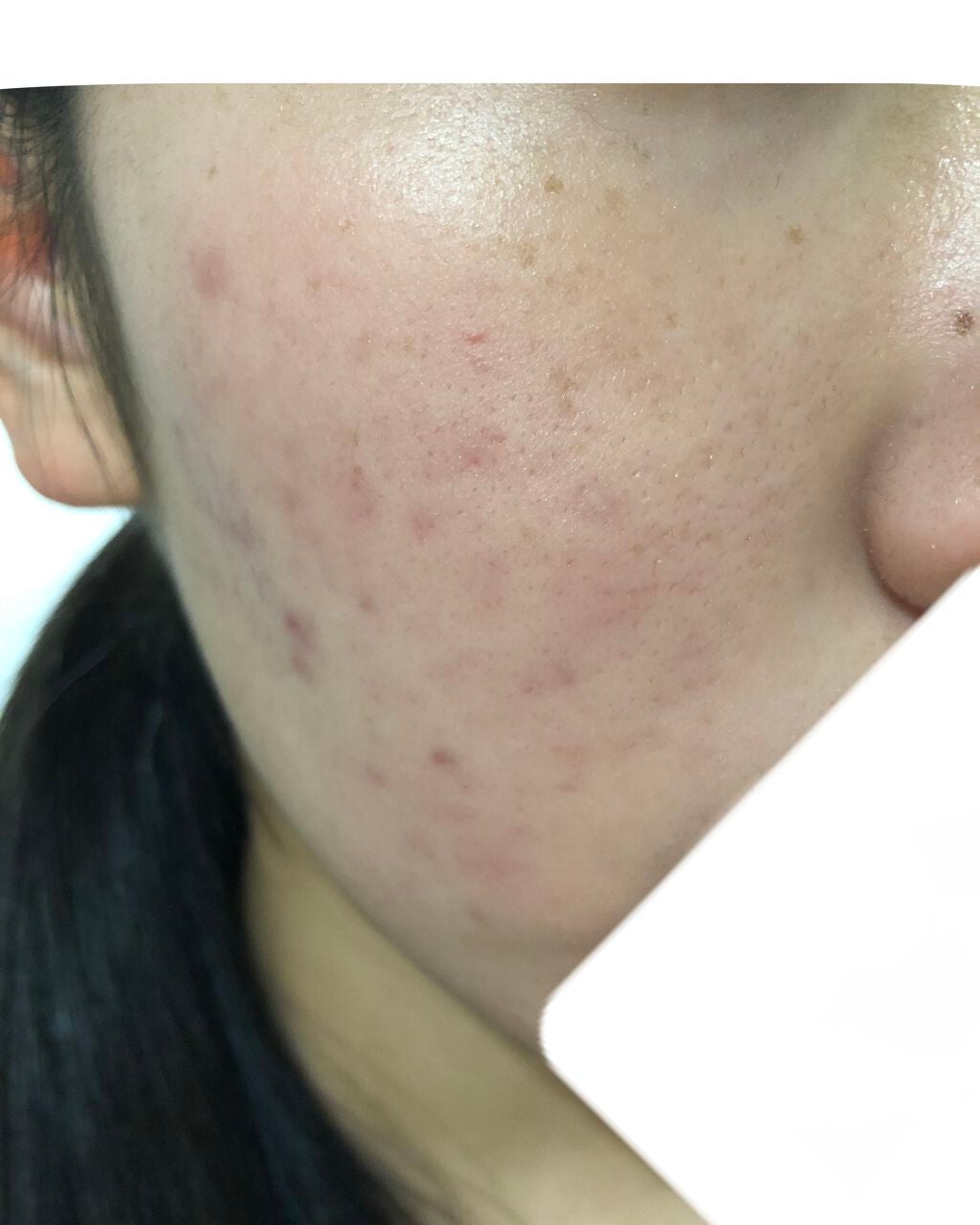 おはぎ🐰 on LIPS 「学年1のニキビ面が2ヶ月で少しマシになった話。2枚目→2020..」(3枚目)