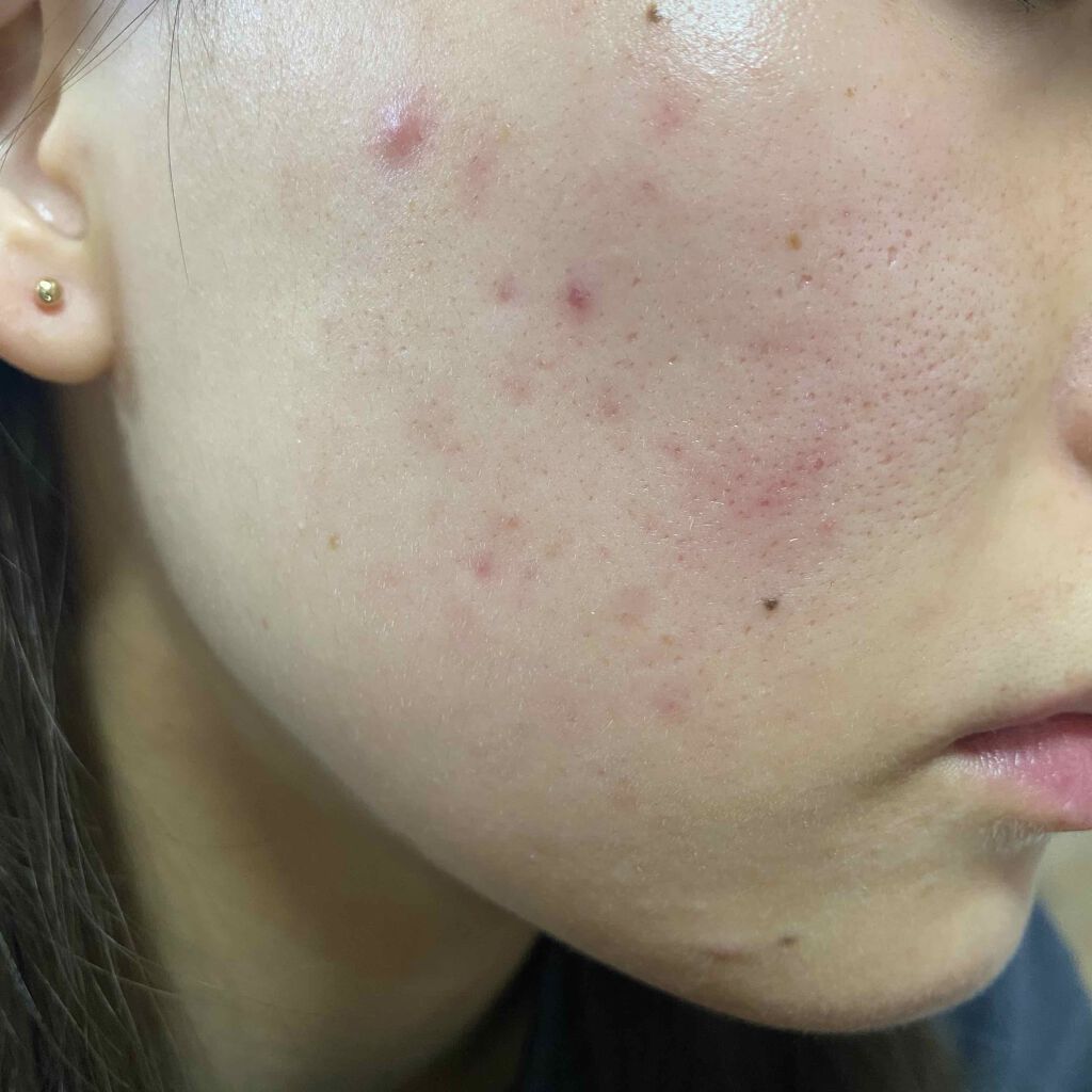 ゼビアックス(医薬品)/マルホ株式会社/その他を使ったクチコミ（2枚目）