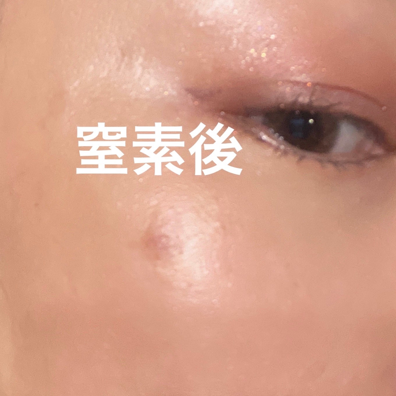 ためしたがり43歳 on LIPS 「4回目の窒素#イボ時間が開いてしまいました。忙しくて💦かなり平..」(2枚目)