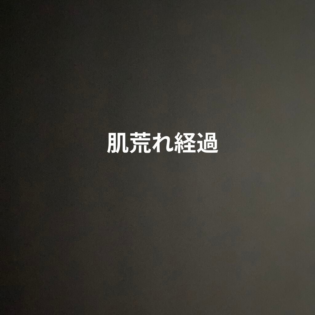 アクネケア セット N/d プログラム/トライアルキットを使ったクチコミ(1枚目)