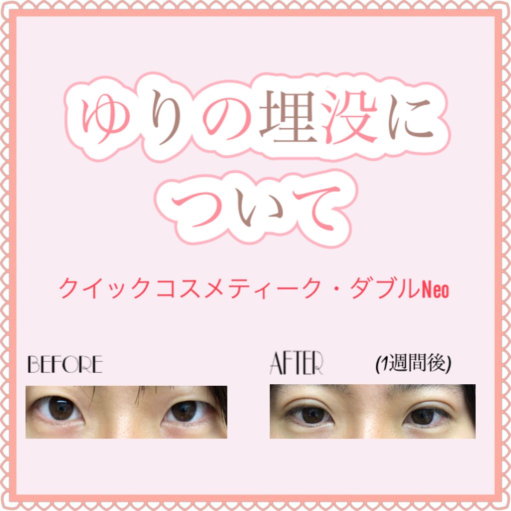 二重整形/その他を使ったクチコミ（1枚目）