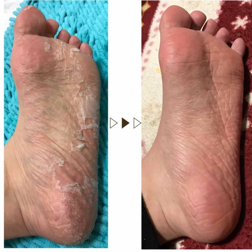 足裏角質パック ティアラローズの香り/EVERYYOU/レッグ・フットケアを使ったクチコミ(4枚目)