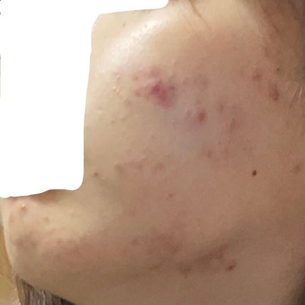 パーフェクトホイップ アクネケア/SENKA(専科)/洗顔フォームを使ったクチコミ(2枚目)