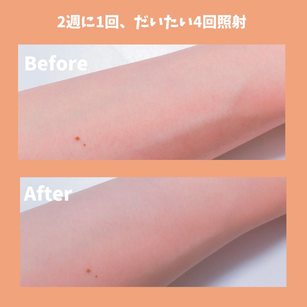 センスエピj/Silk’n/家庭用脱毛器を使ったクチコミ（3枚目）