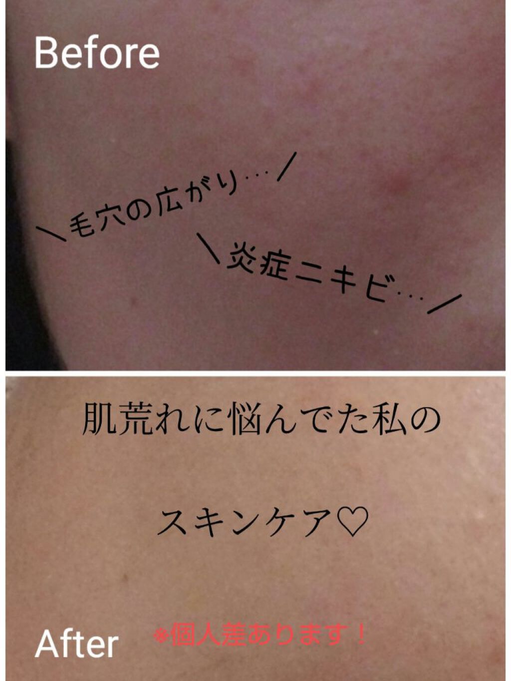 ペアアクネクリームW(医薬品)/ペア/その他を使ったクチコミ（1枚目）