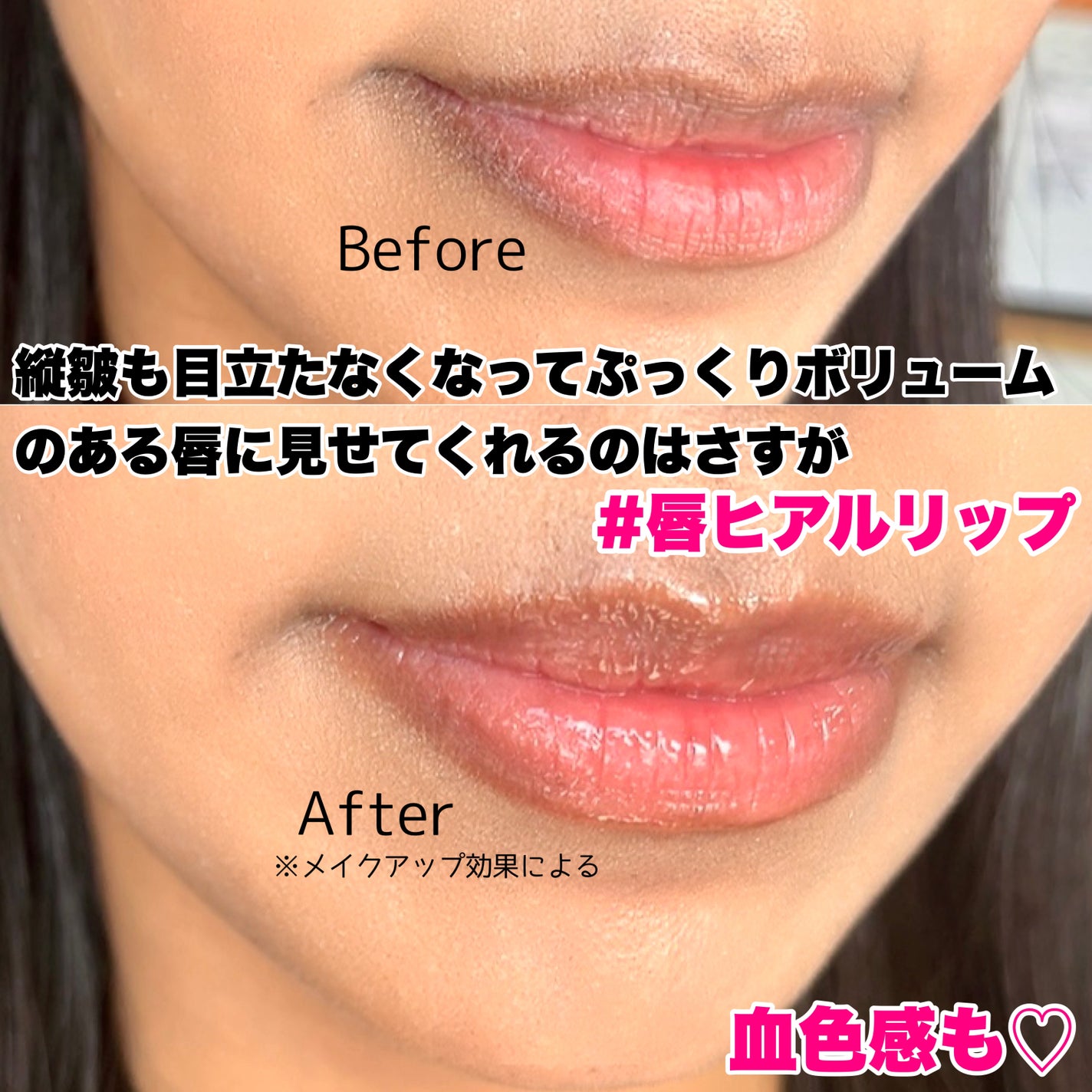 ニードルプランパー 高熱フィグ/Ui2./リッププランパーを使ったクチコミ(5枚目)