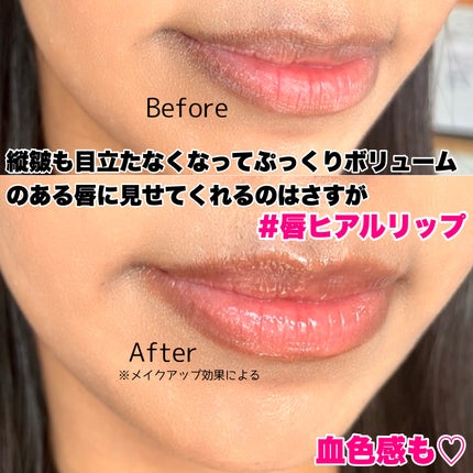 ニードルプランパー 高熱フィグ/Ui2./リッププランパーを使ったクチコミ(5枚目)