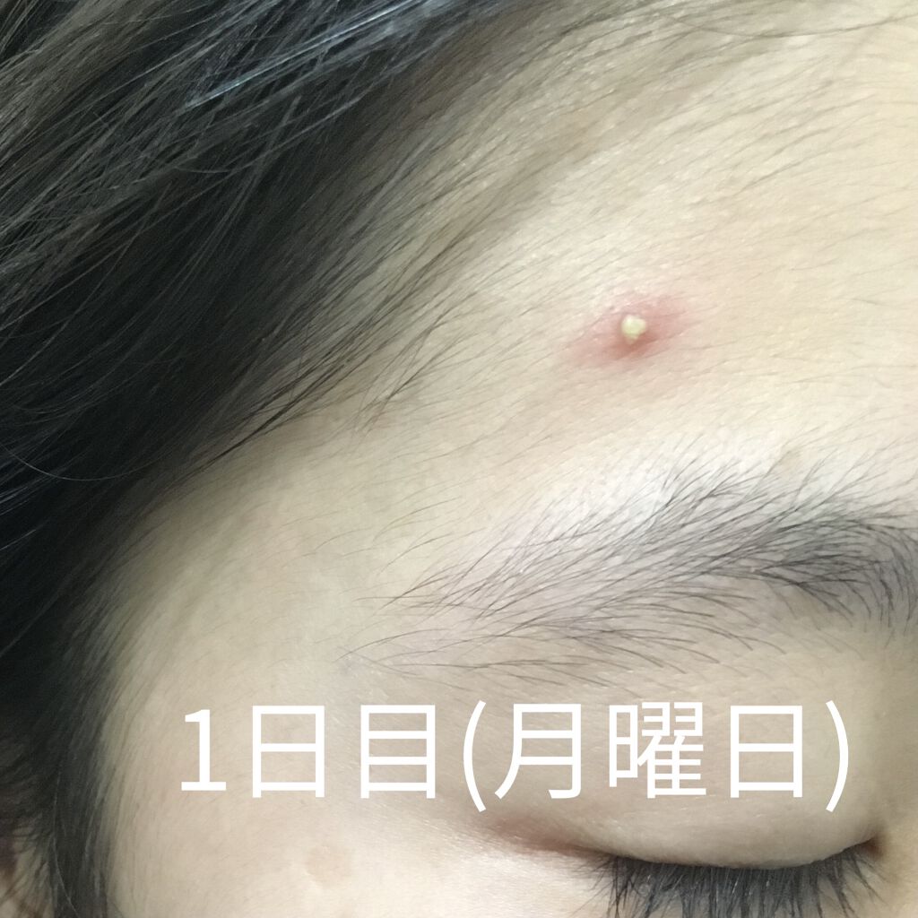 ペアアクネクリームW(医薬品)/ペア/その他を使ったクチコミ（3枚目）