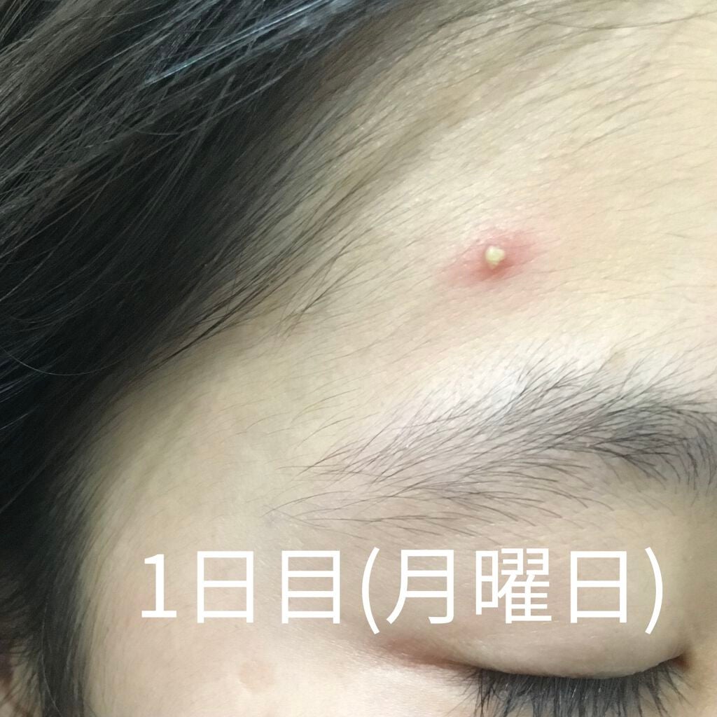 ペアアクネクリームW(医薬品)/ペア/その他を使ったクチコミ(3枚目)