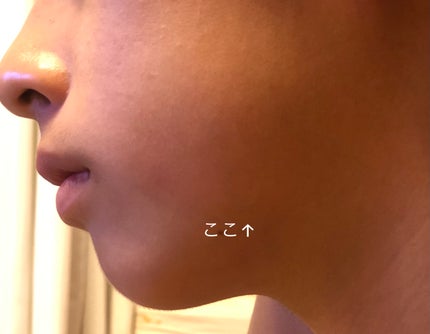 極薄透明パッチ nikipa!/金冠堂/にきびパッチを使ったクチコミ(4枚目)