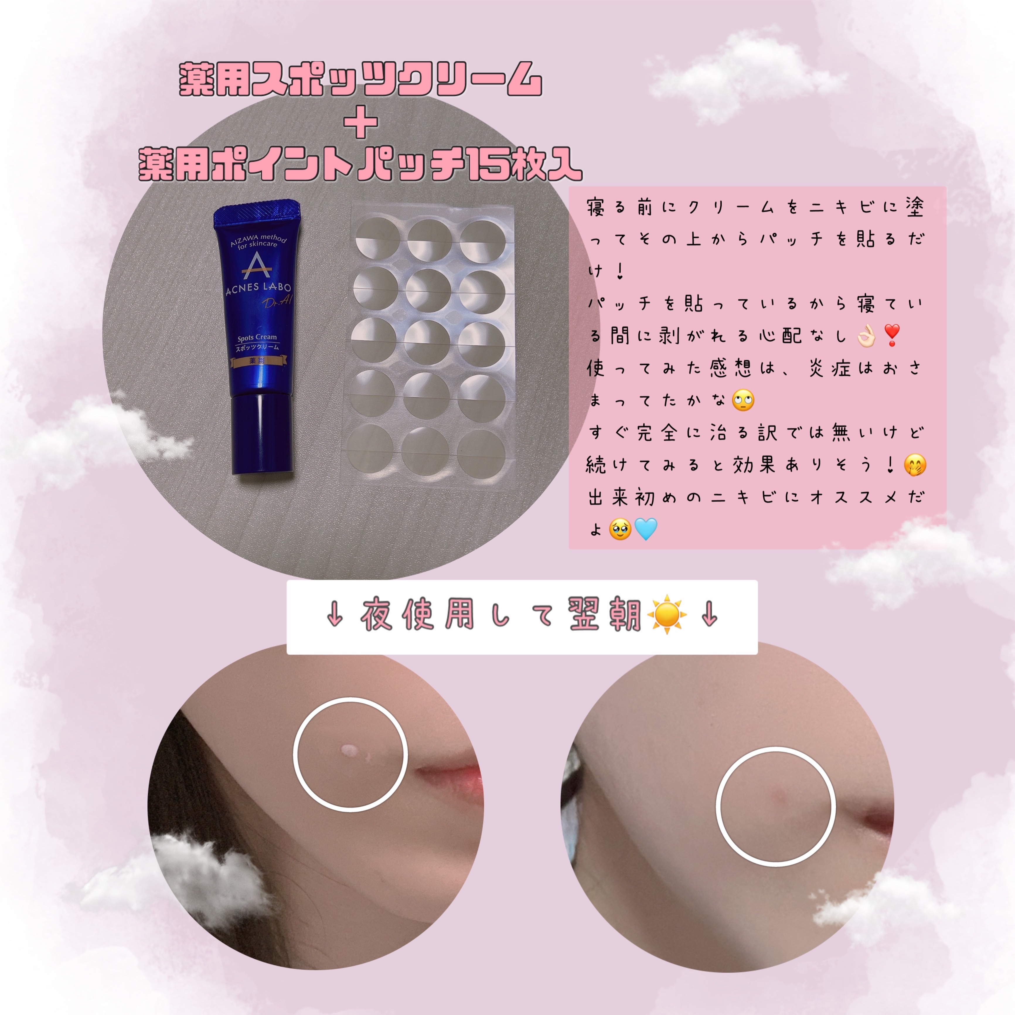 薬用ニキビケア スポッツクリーム/アクネスラボ/フェイスクリームを使ったクチコミ（3枚目）