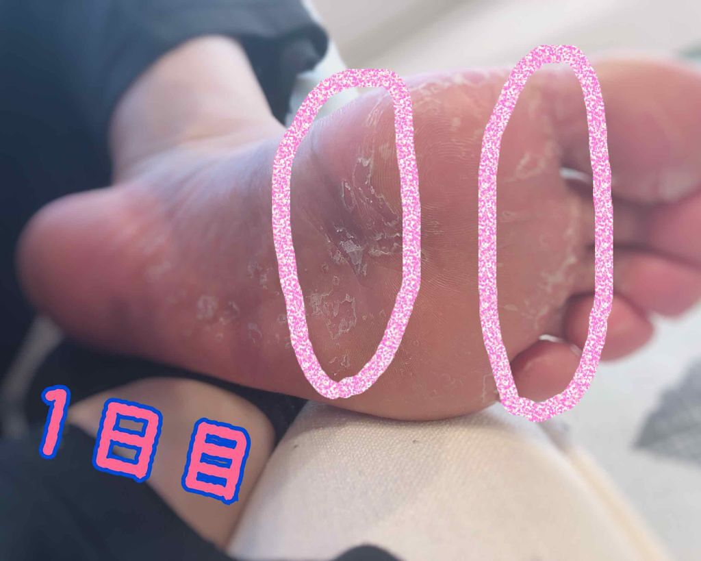 フットピーリングパック ペロリン ローズ/素数/レッグ・フットケアを使ったクチコミ(2枚目)