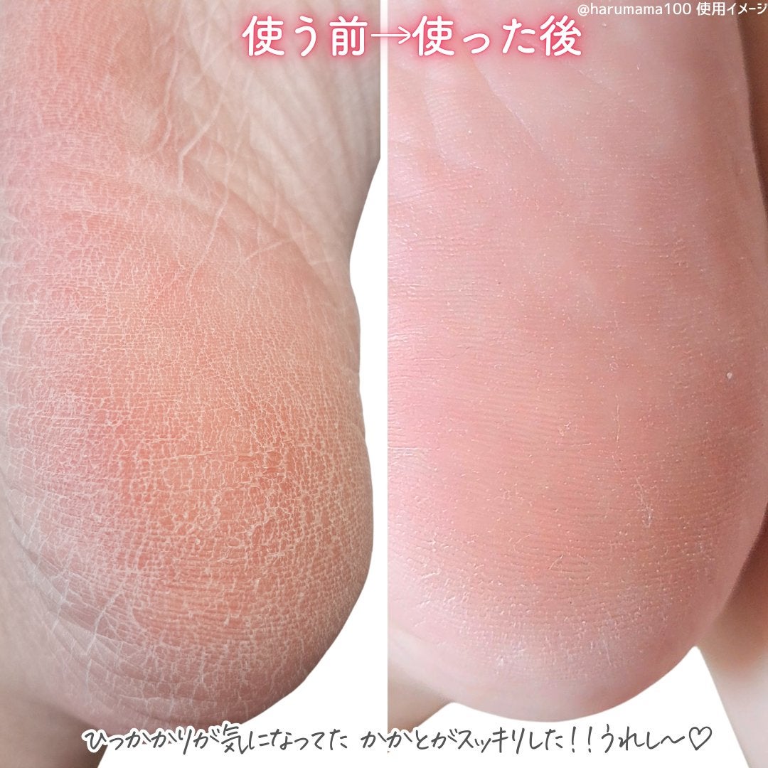 ベビーフット フィグティーの香り 60分タイプ Mサイズ/ベビーフット/レッグ・フットケアを使ったクチコミ(6枚目)