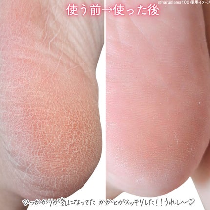 ベビーフット フィグティーの香り 60分タイプ Mサイズ/ベビーフット/レッグ・フットケアを使ったクチコミ(6枚目)