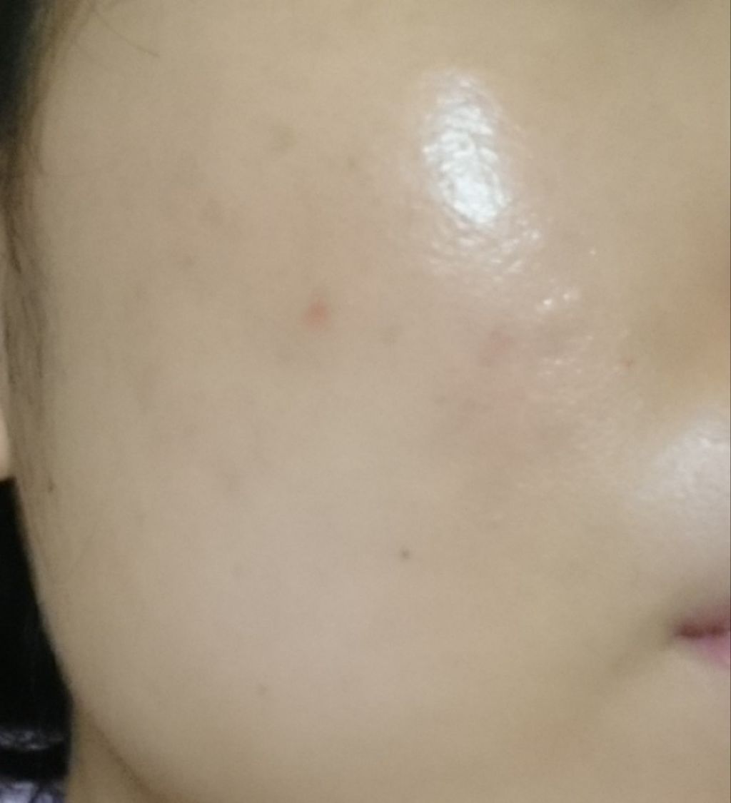 Nexcare/3M nexcare/にきびパッチを使ったクチコミ（3枚目）