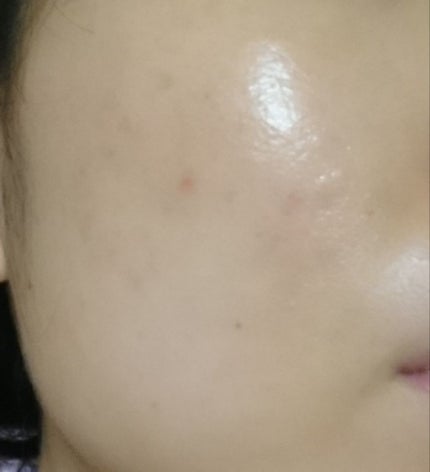 Nexcare/3M nexcare/にきびパッチを使ったクチコミ(3枚目)