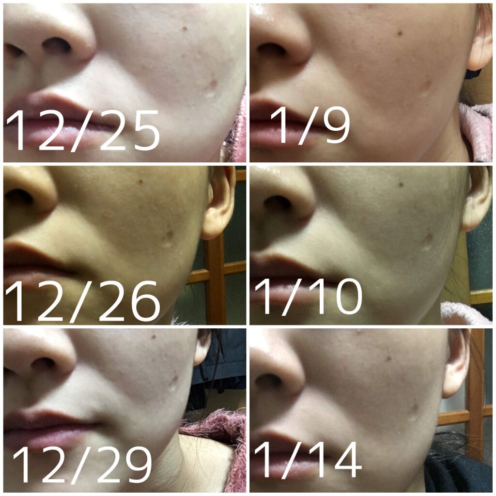 リンクルショット メディカル セラム/リンクルショット/アイケア・アイクリームを使ったクチコミ(2枚目)