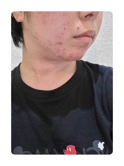 九州育ちのじゃがいもちゃん on LIPS 「汚肌注意⚠️○ニキビ観察2日目○前日と余り変わらず。何年間もい..」(3枚目)