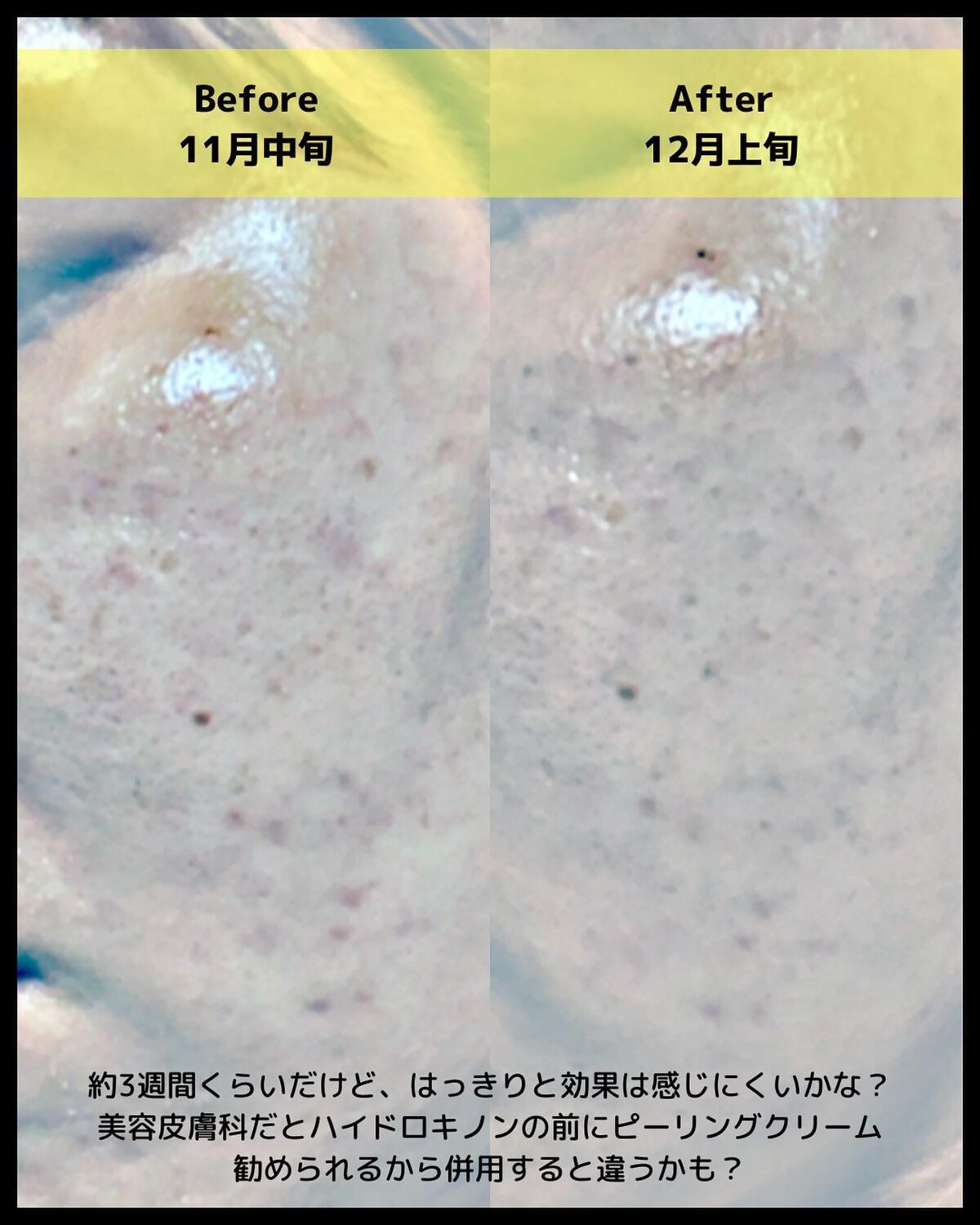 HYDROQUINONE BRIGHTNING SERUM｜コスデバハの効果に関する