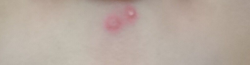 Nexcare/3M nexcare/にきびパッチを使ったクチコミ（2枚目）