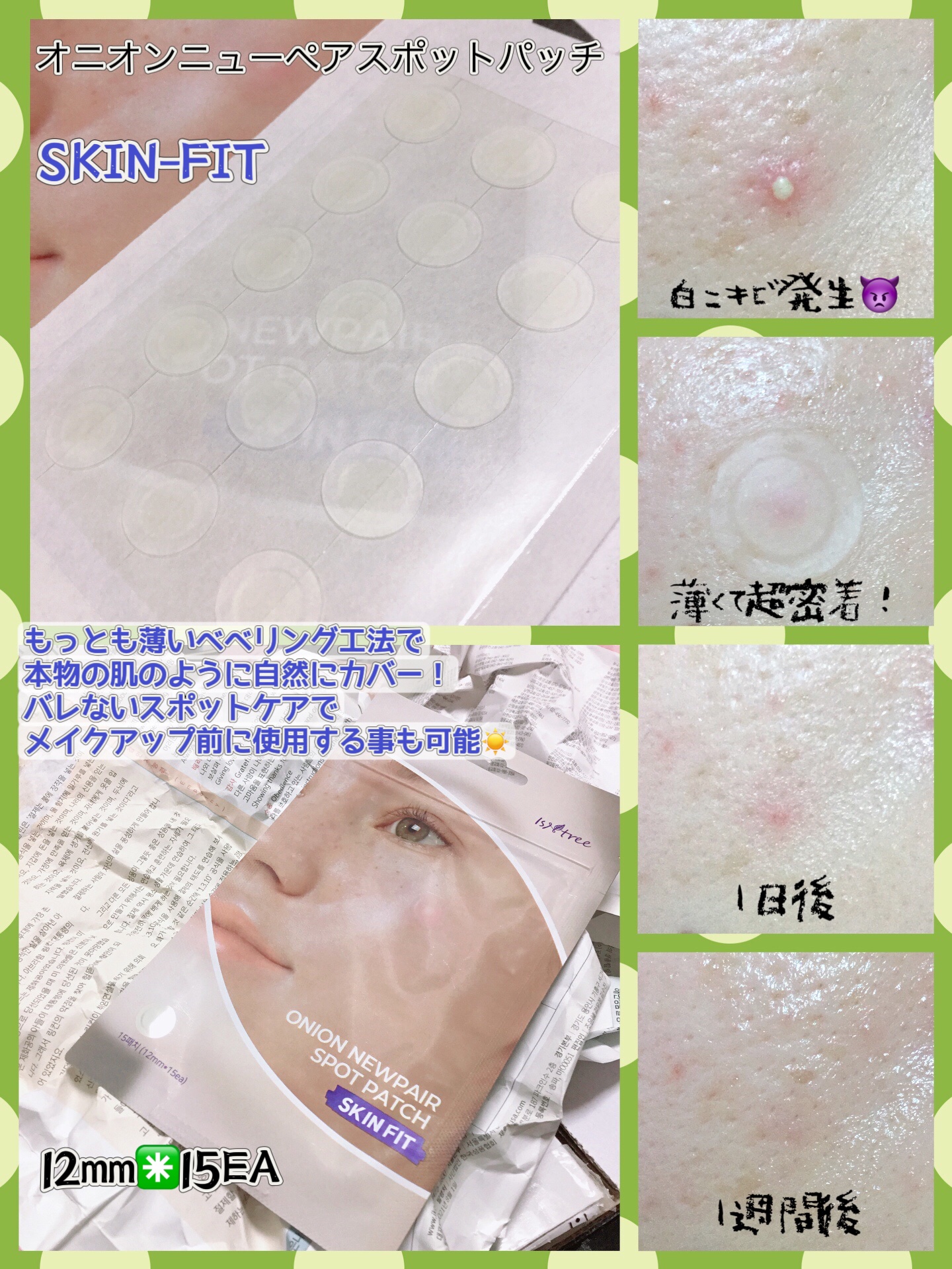 Isntree オニオン ニューペア スポットパッチ ベーシックのクチコミ「イズエンツリー (@isntree_jp )
オニオンニューペアスポットパッチ💜


吹き出物.....」（3枚目）