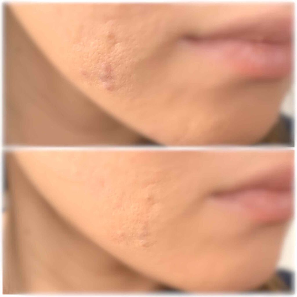 スティックコンシーラーA/KATE/スティックコンシーラーを使ったクチコミ(2枚目)