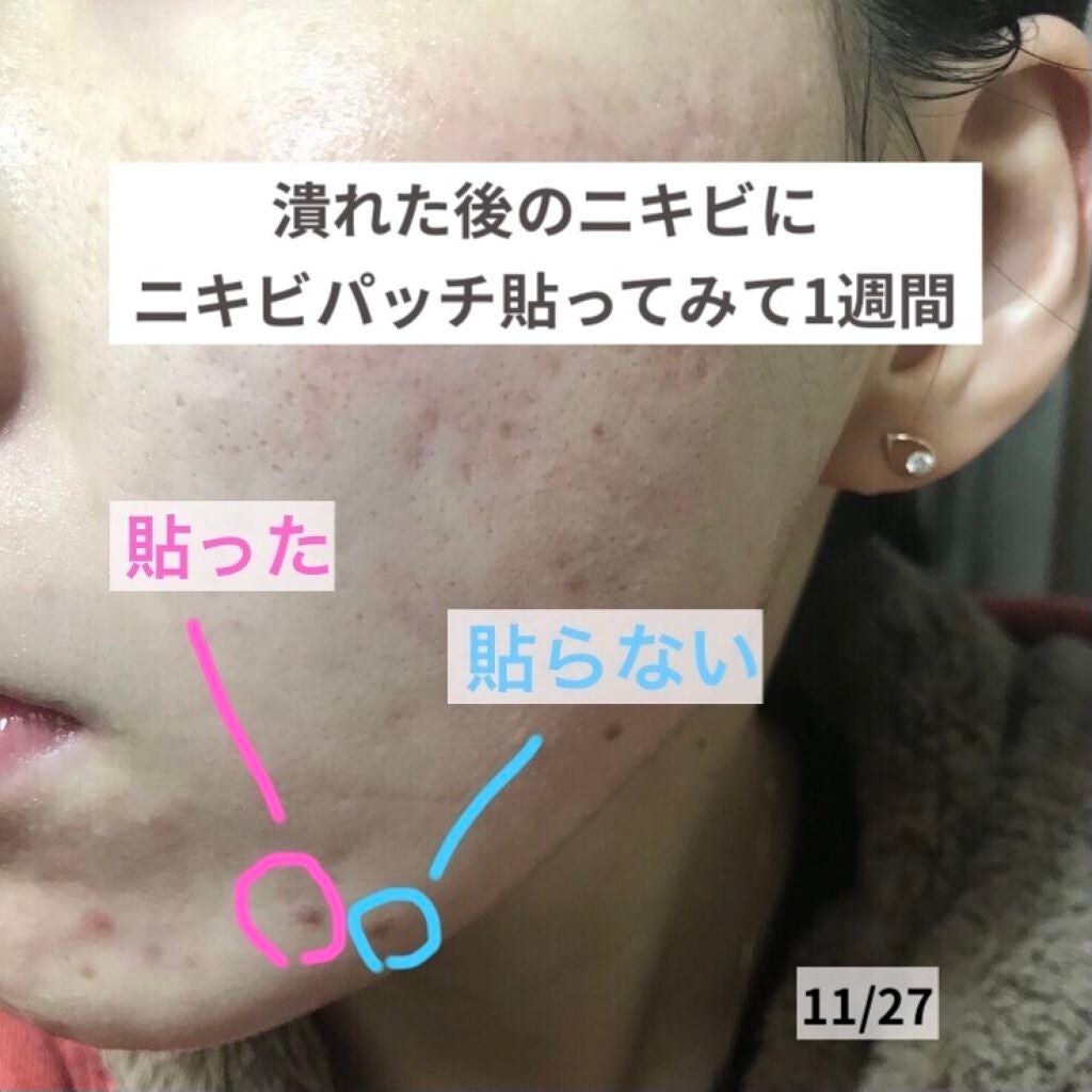 ゼロスポットパッチ/Today’s Cosme/にきびパッチを使ったクチコミ(1枚目)