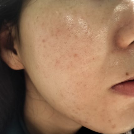 AHA 30% + BHA 2% Peeling Solution/The Ordinary/ピーリングを使ったクチコミ(1枚目)