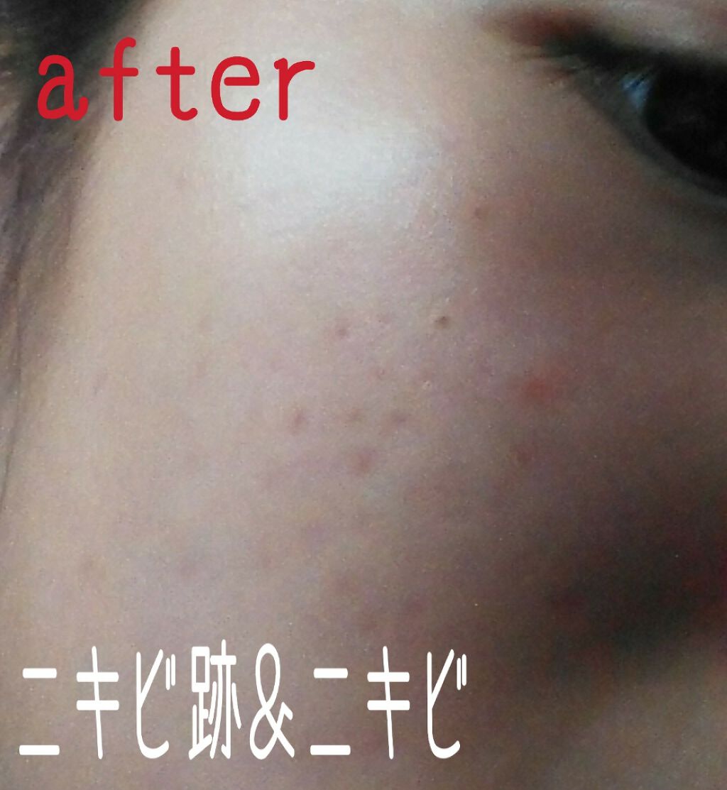 ノブ Ａ アクネソープ/NOV/洗顔石鹸を使ったクチコミ（2枚目）