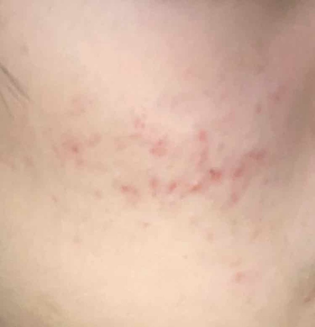 Yuu. on LIPS 「助けてください..!頬全体にニキビ跡が広がってもう一年以上経つ..」(2枚目)