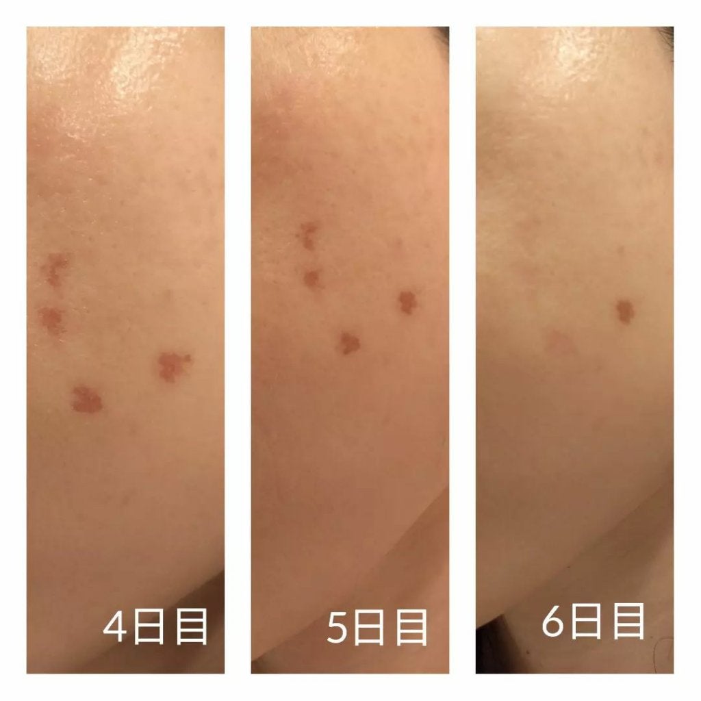 あにゃにゃ♡フォロバ100♡ on LIPS 「5月にしたピコスポット🍅※最後の写真のみ1月した別箇所※今回は..」(4枚目)