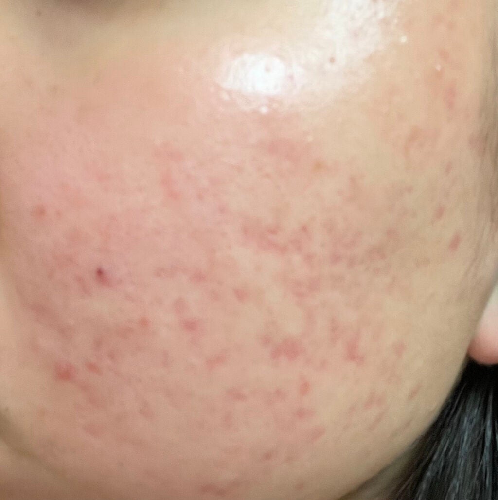 あかね on LIPS 「高校3年なのですが中学位から肌荒れに悩まされています😭これでも..」(3枚目)