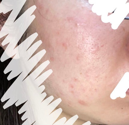 オードムーゲ 薬用ローション(ふきとり化粧水)/オードムーゲ/拭き取り化粧水を使ったクチコミ(2枚目)