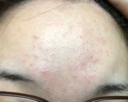 オードムーゲ 薬用ローション(ふきとり化粧水)/オードムーゲ/拭き取り化粧水を使ったクチコミ(2枚目)