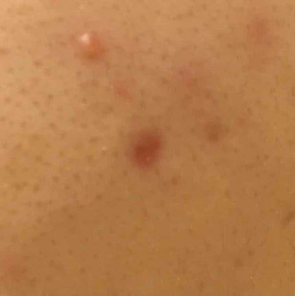 薬用 しみ 集中対策 美容液/メラノCC/美容液を使ったクチコミ(2枚目)