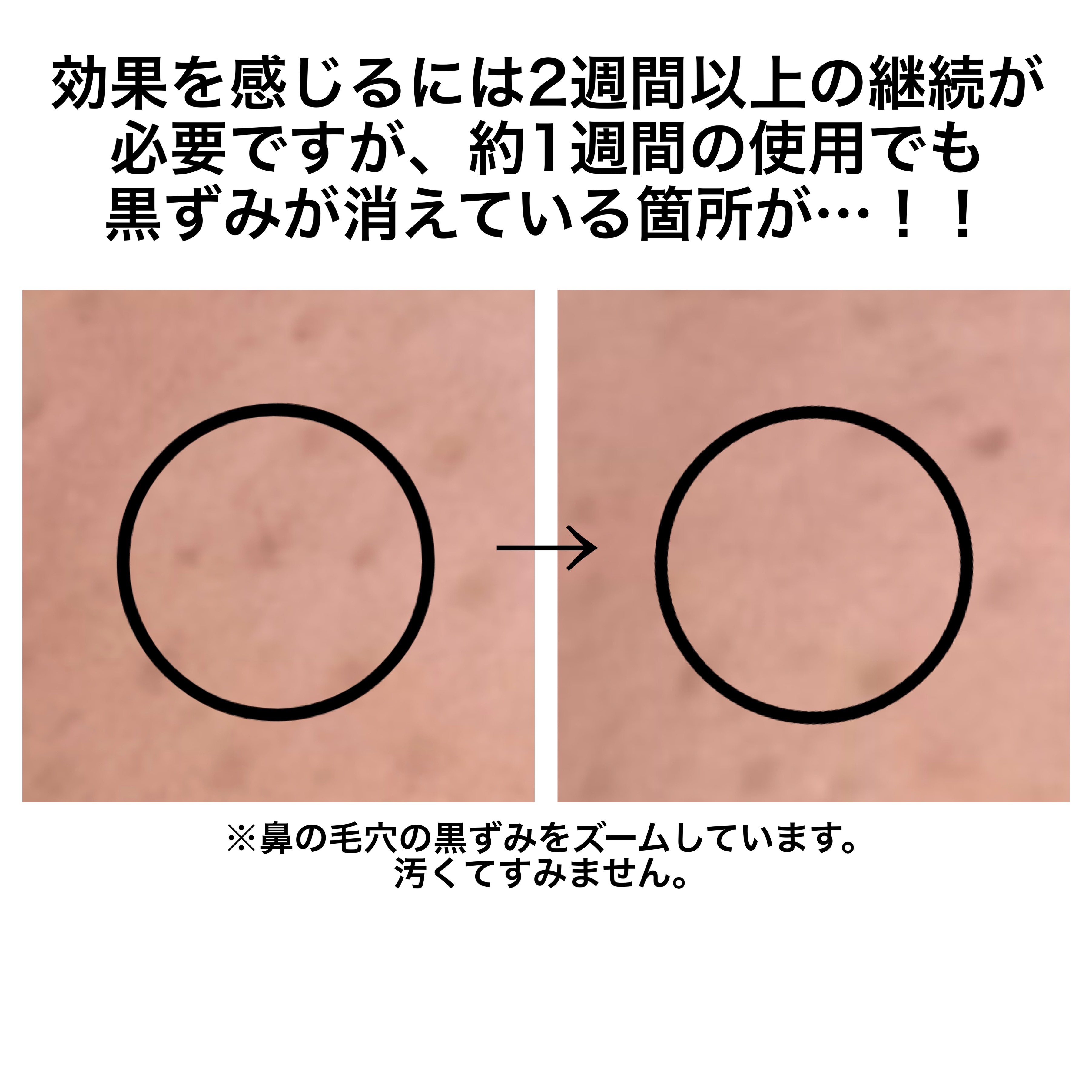 毛穴アンプル/ブラン/美容液を使ったクチコミ（3枚目）