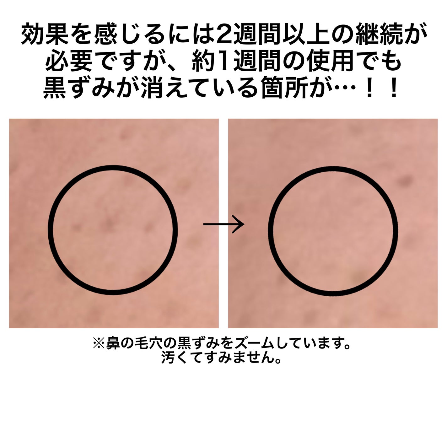 毛穴アンプル/ブラン/美容液を使ったクチコミ(3枚目)