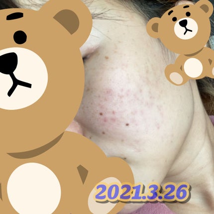 ロゼット洗顔パスタ アクネクリア/ロゼット/洗顔フォームを使ったクチコミ(3枚目)