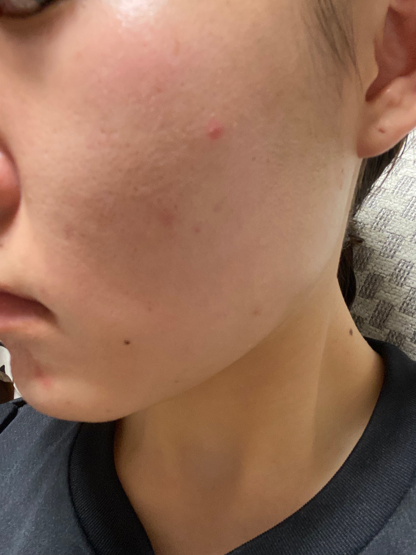 りら on LIPS 「だいぶ肌綺麗になったなぁ…(まだ全然ニキビできるし、ニキビ跡と..」(1枚目)