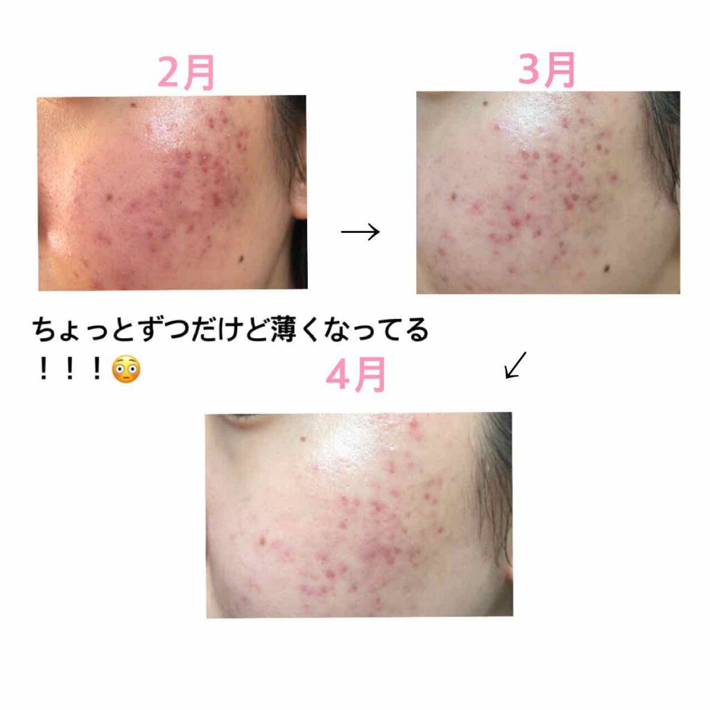 N10+Z1フェイスセラム /The Ordinary/美容液を使ったクチコミ（2枚目）